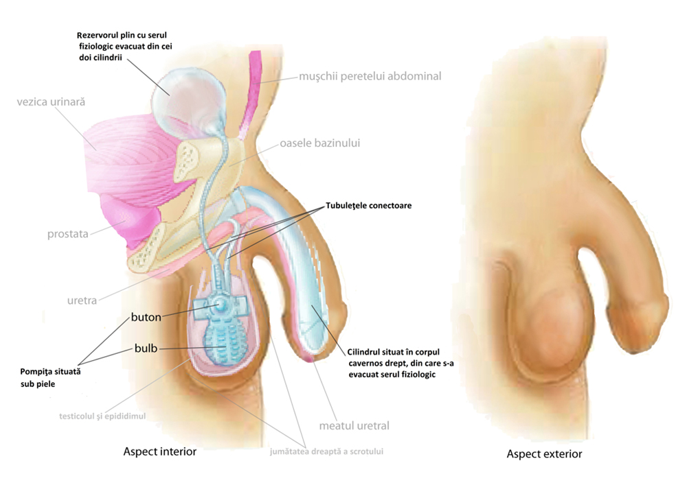 penis ascuns în erecție după un curs de steroizi nu există erecție