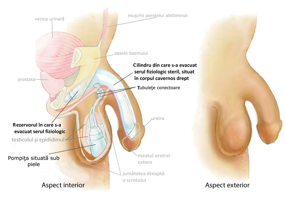 operație pentru restabilirea erecției în timpul unei erecții un testicul se ridică